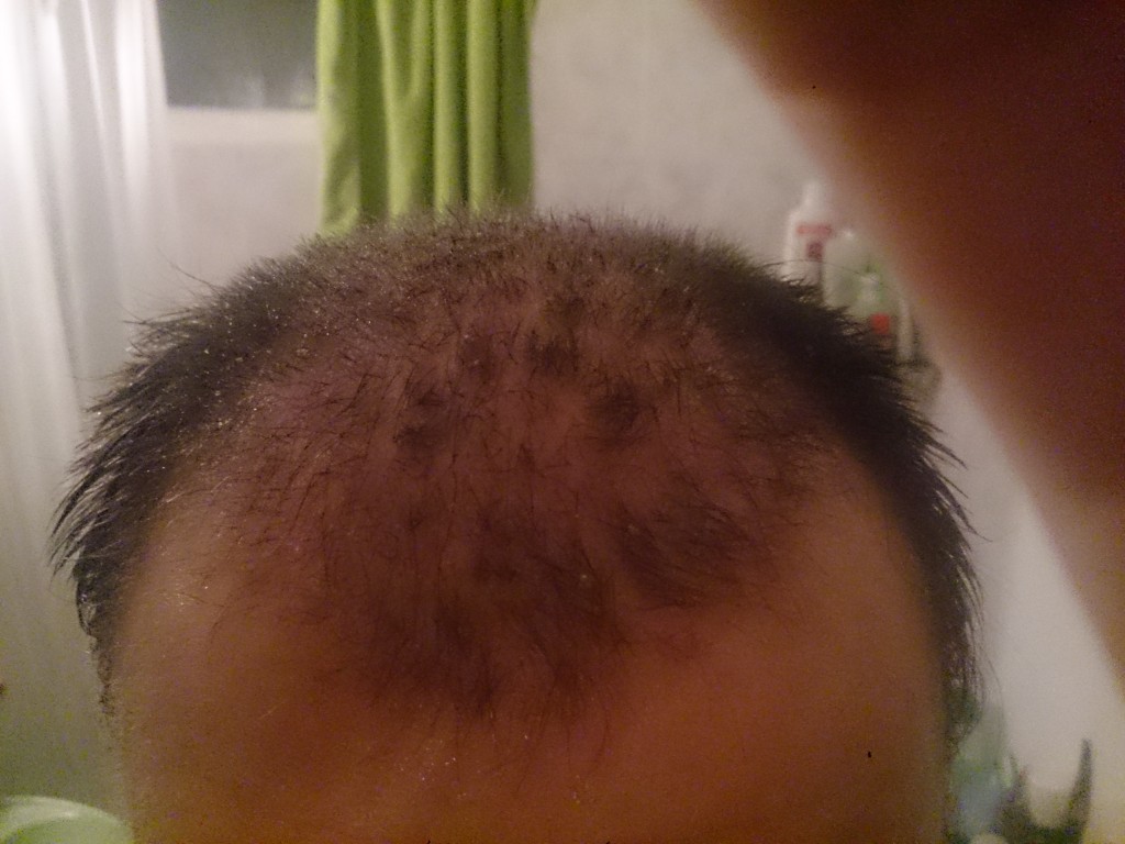 Frente transplante de pelo