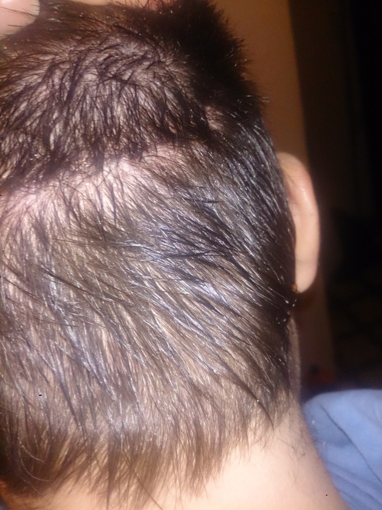 Cicatriz del transplante de pelo